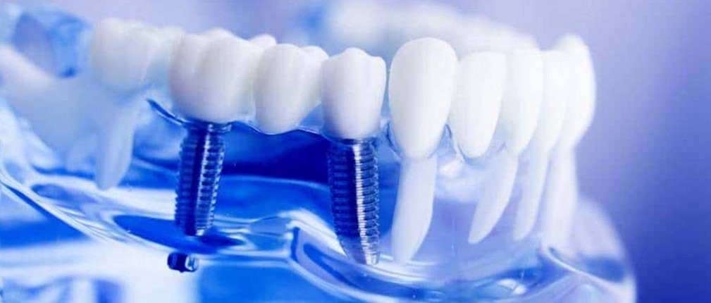 Implantološka procedura