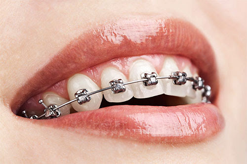 Nevidele braces aparati